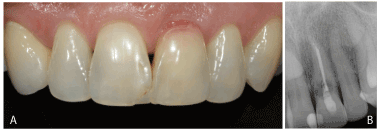 Biomimetic Zirconia Abutment for Single Implant Supported Restoration: A Case Report