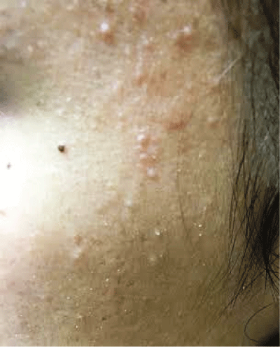 Eruptive Vellus Hair Cysts: Is it a Disease or a Phenomenon?