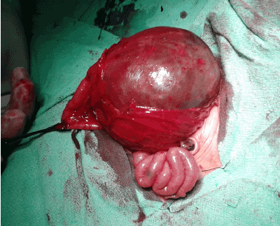: Intra operative picture showing Abrupt change in caliber of the colon