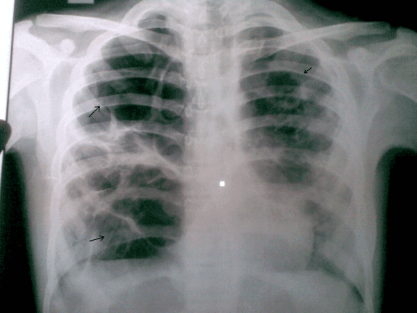 Plain chest radiograph (postero anterior view)