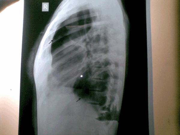 Plain chest radiograph (lateral view)