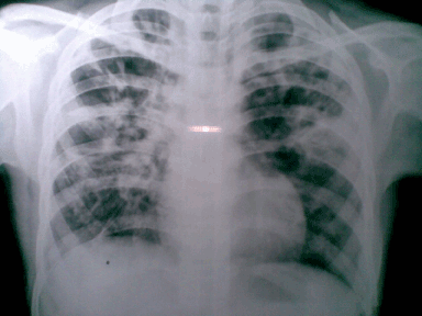 Follow up plain chest radiograph (postero anterior view)